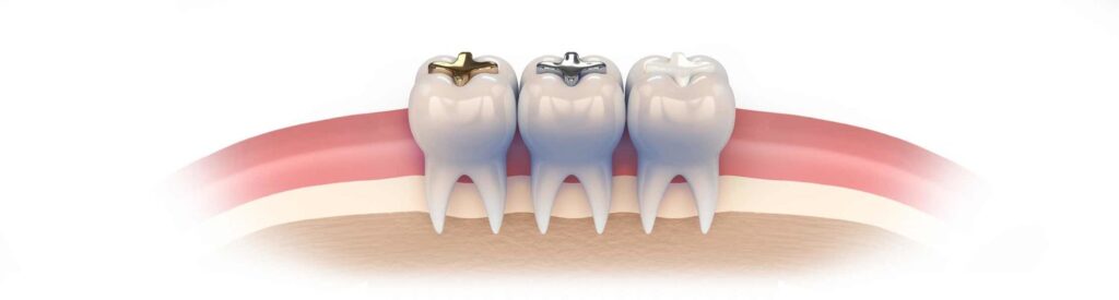 How do factors influence the number of fillings